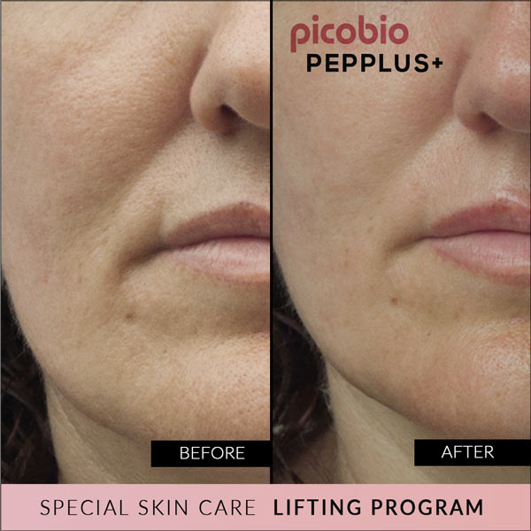 PicoBio PEPPLUS+ Special SkinCare Lifting Program – 4 treatments