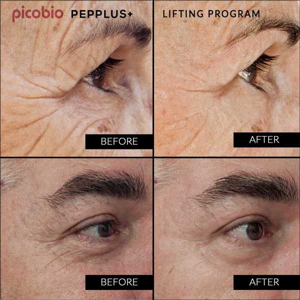 PicoBio PEPPLUS+ Special SkinCare Lifting Program – 4 treatments